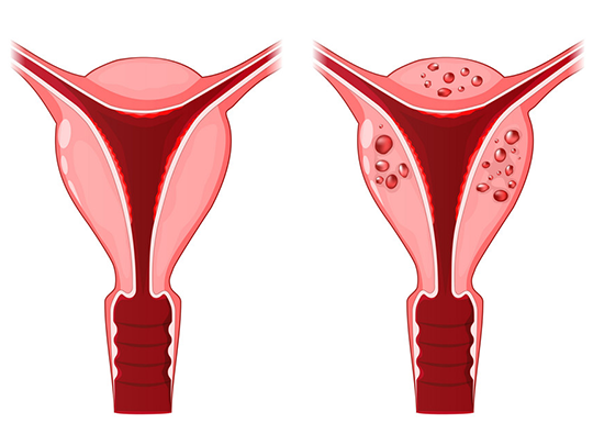 Quais os sintomas e tratamentos da adenomiose?