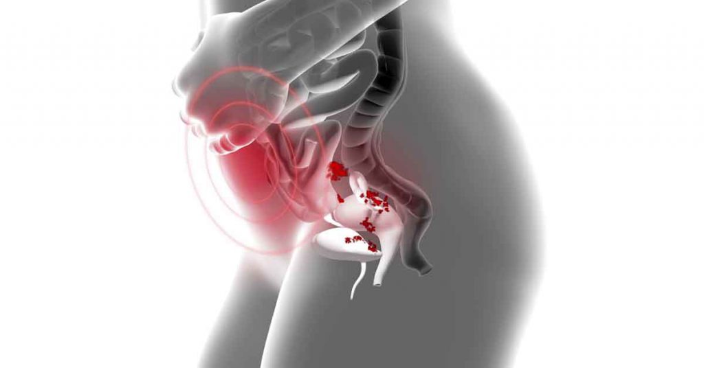 Cirurgia de Endometriose: Quando é a Opção Recomendada pelos Especialistas