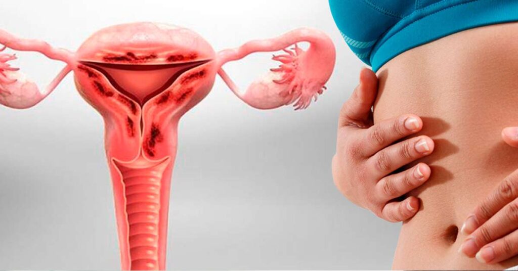 Benefícios da Cirurgia de Adenomiose para a saúde uterina